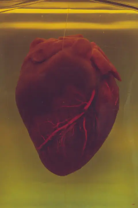 A preserved human heart suspended in fluid inside a glass jar, with its coronary arteries visible