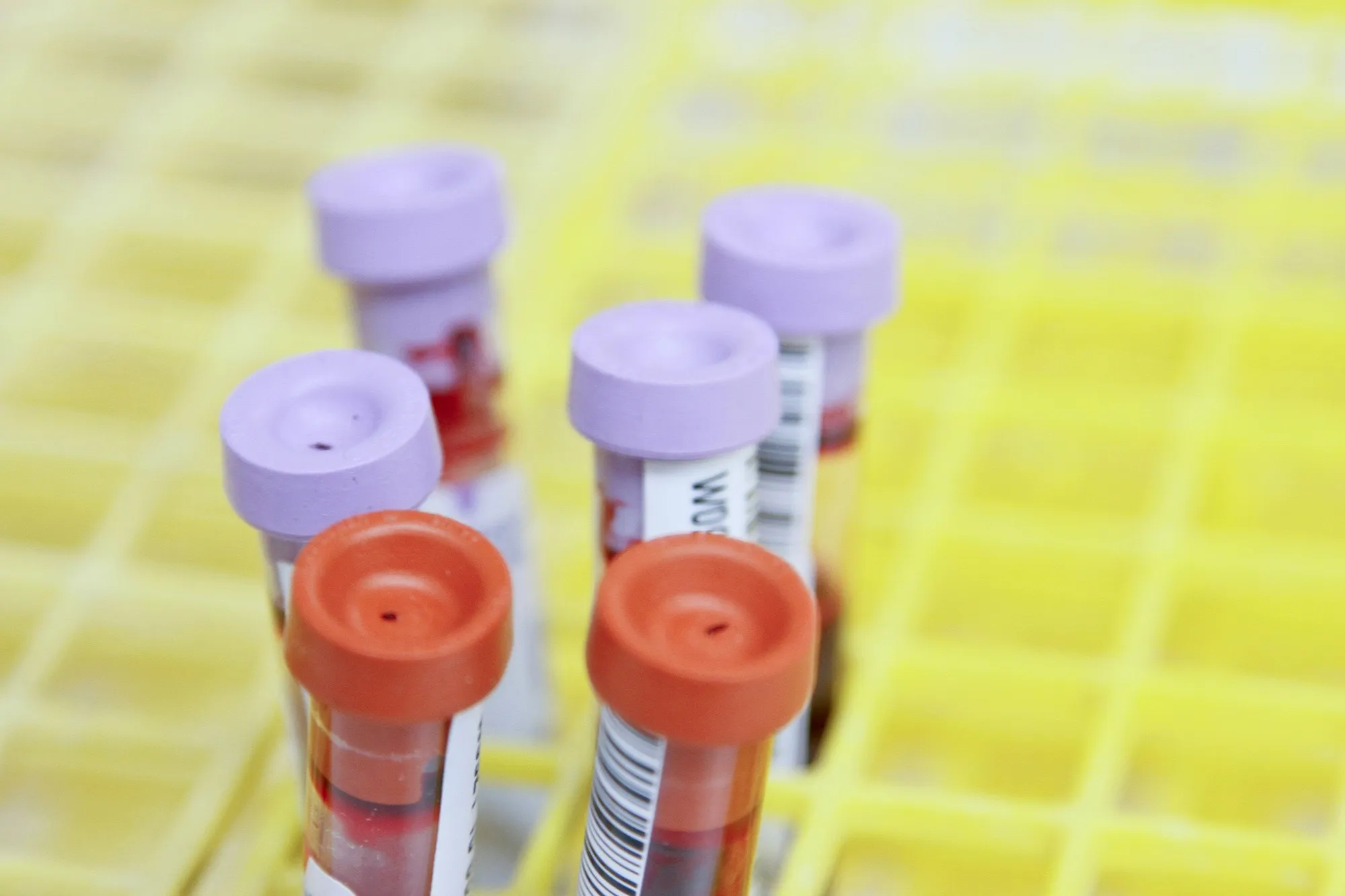 Close-up of test tubes with blood samples in a lab tray, representing diagnostic tests like HbA1c for monitoring diabetes risk.
