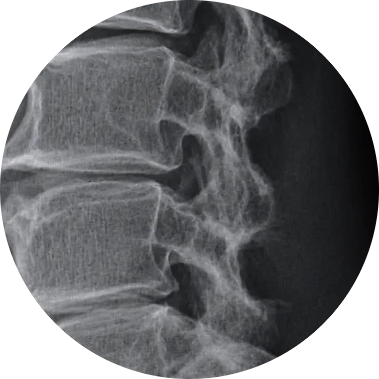 DEXA Scan
