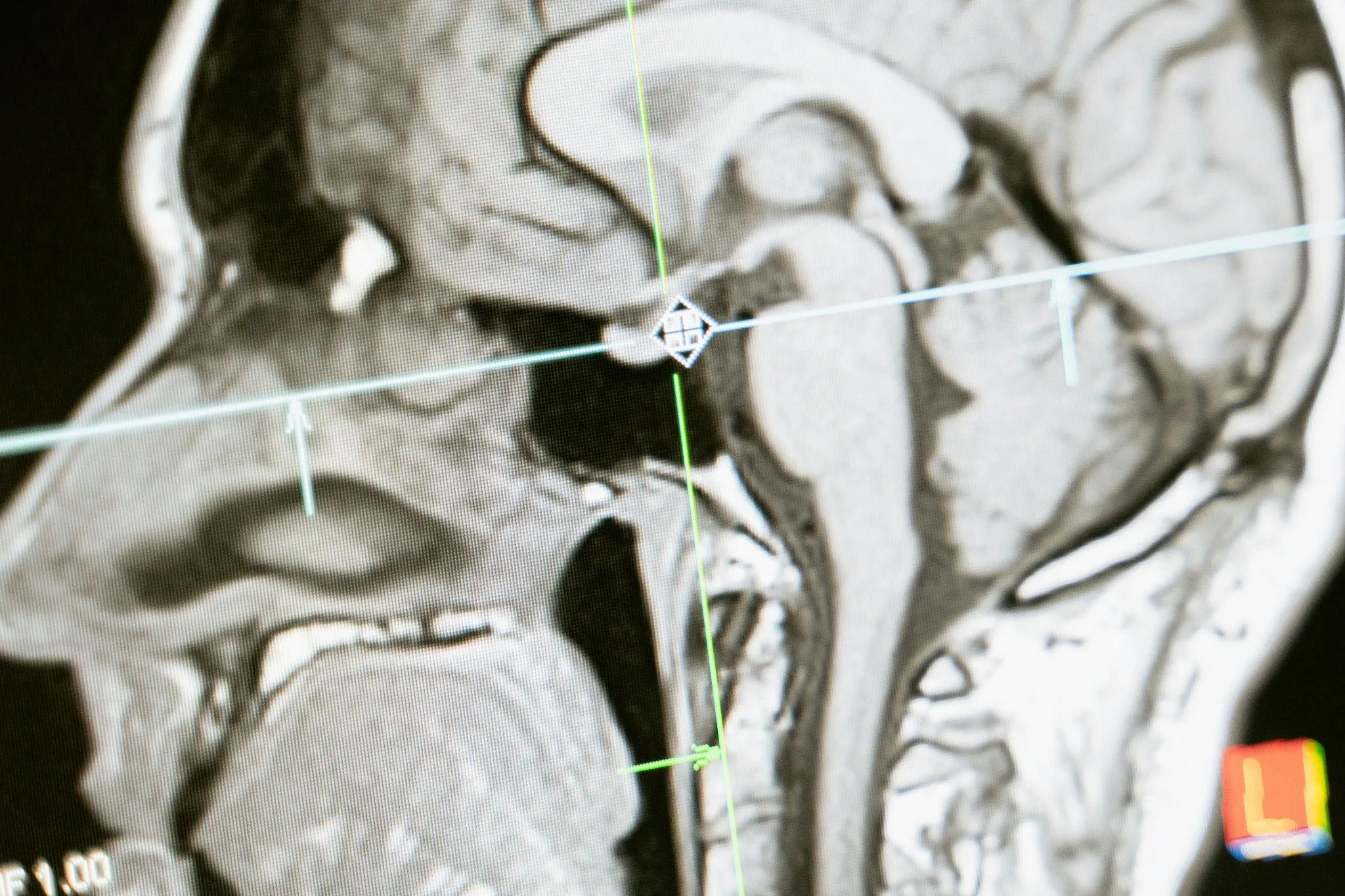 What Is the Gut–Brain Connection?