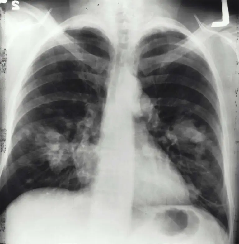 What’s Alpha-1 Antitrypsin Deficiency