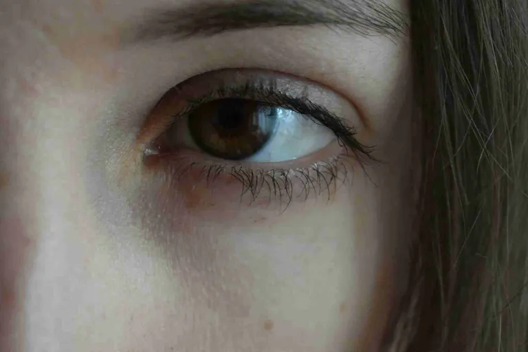 Dark Under-Eyes: What Causes Them and How to Fix Them