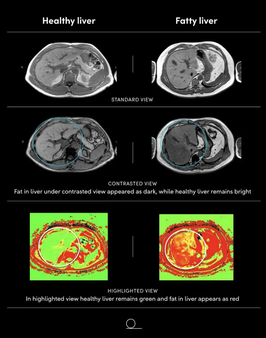 Prenuvo MRI comparison of a healthy liver and a fatty liver across standard, contrasted, and highlighted views