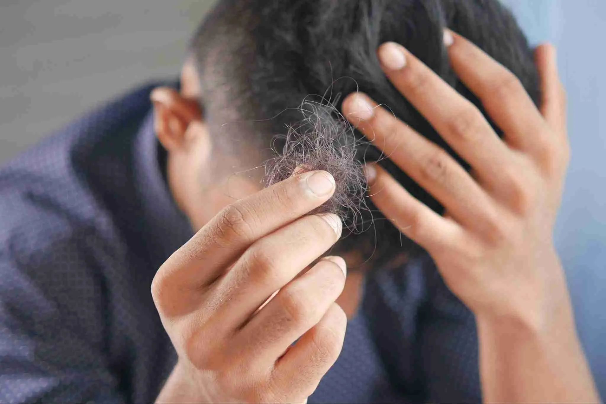 What’s Causing Your Hair to Fall Out? Everything You Need to Know About Hair Loss